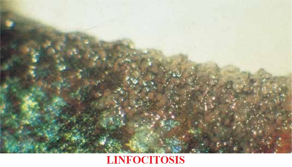 Linfocitosis del koi 